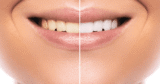 Tooth Whitening Choices: Which One Is Proper for You?