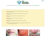 Chilly Sore Remedy – Be taught Find out how to Get Rid Of Chilly Sores Sooner
